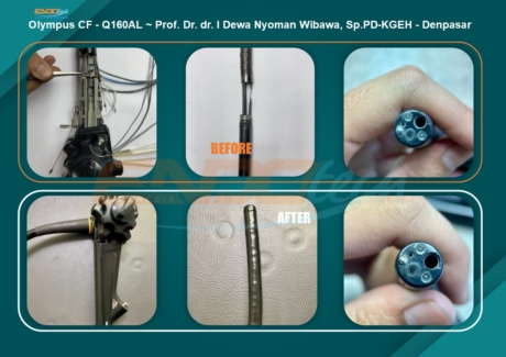 Olympus CF - Q160AL ~ Prof. Dr. dr. I Dewa Nyoman Wibawa, Sp.PD-KGEH - Denpasar